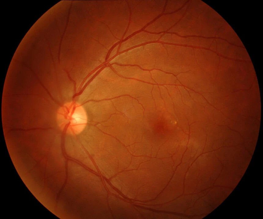 Na zdjęciu OCT widać warstwy włókien nerwowych i tarczę nerwu wzrokowego.
