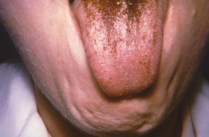 Jedną z przyczyn powstania włochatego języka moze być antyniotykoterapia (CDC, CC BY-NC)