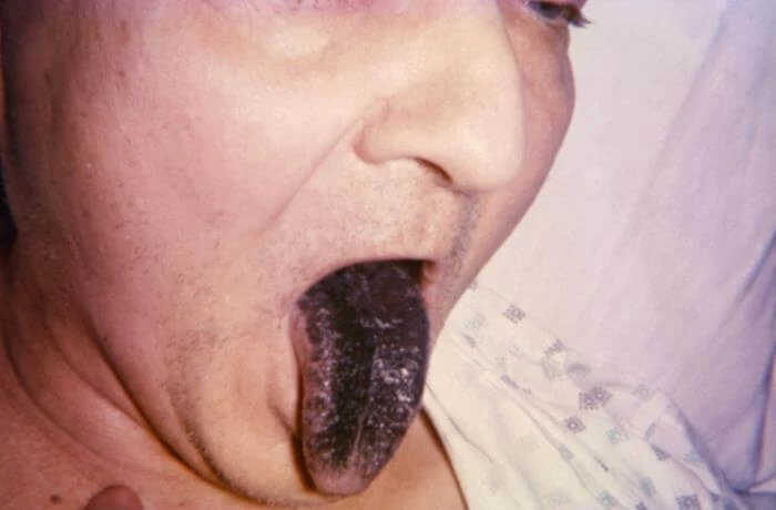 O czym świadczy czarny język? W jamie ustnej doszło do nadmietnego rozwoju bakterii (CDC CC BY-NC)