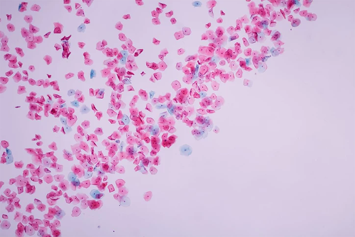 Komórki nabłonkowe szyjki macicy. Co wpływa na ryzyko zachorowania na raka szyjki macicy? I kiedy stosuje się leczenie?