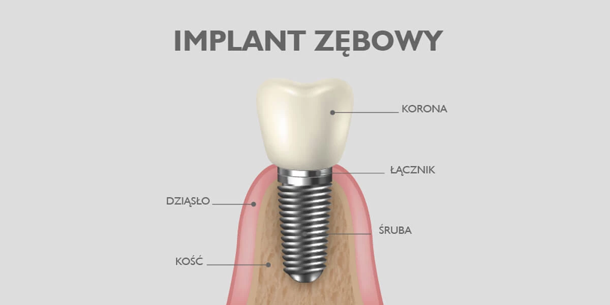 Konsultacja z implantologiem to pierwszy krok leczenia