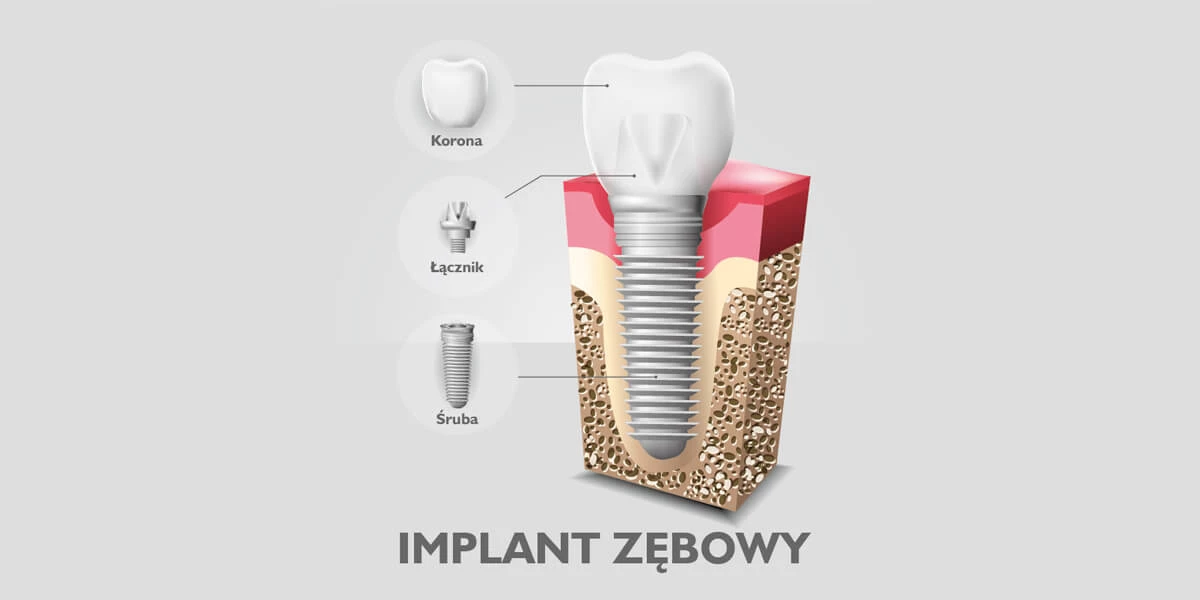 Implant zębowy z powodzeniem zastępuje brakujący ząb