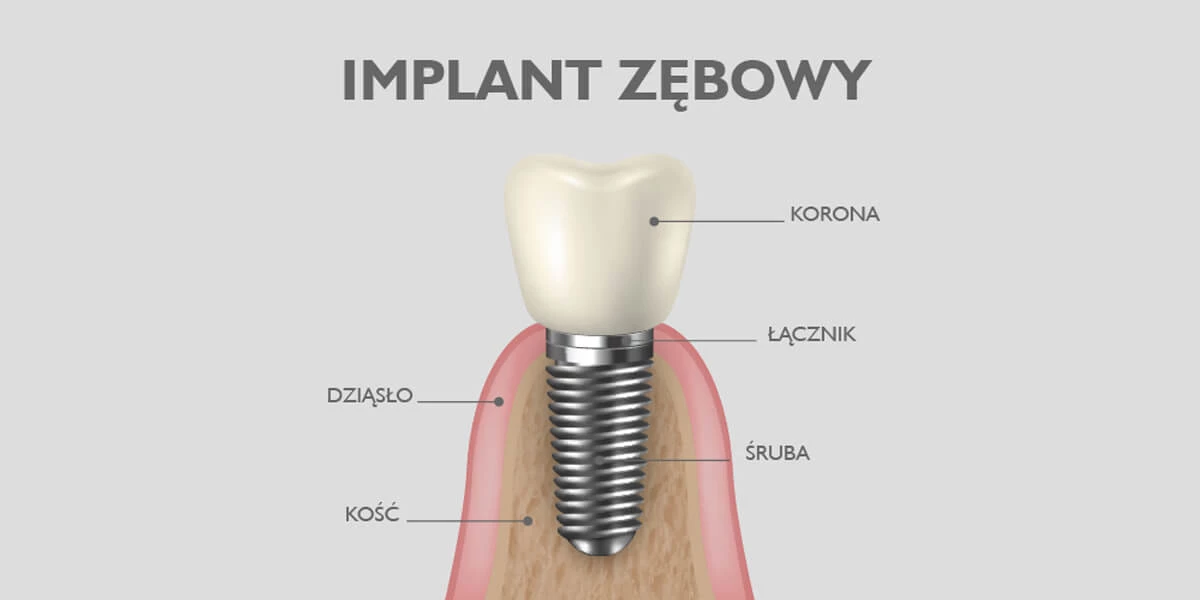 Implant zęba to śruba, którą wkręca się w kość