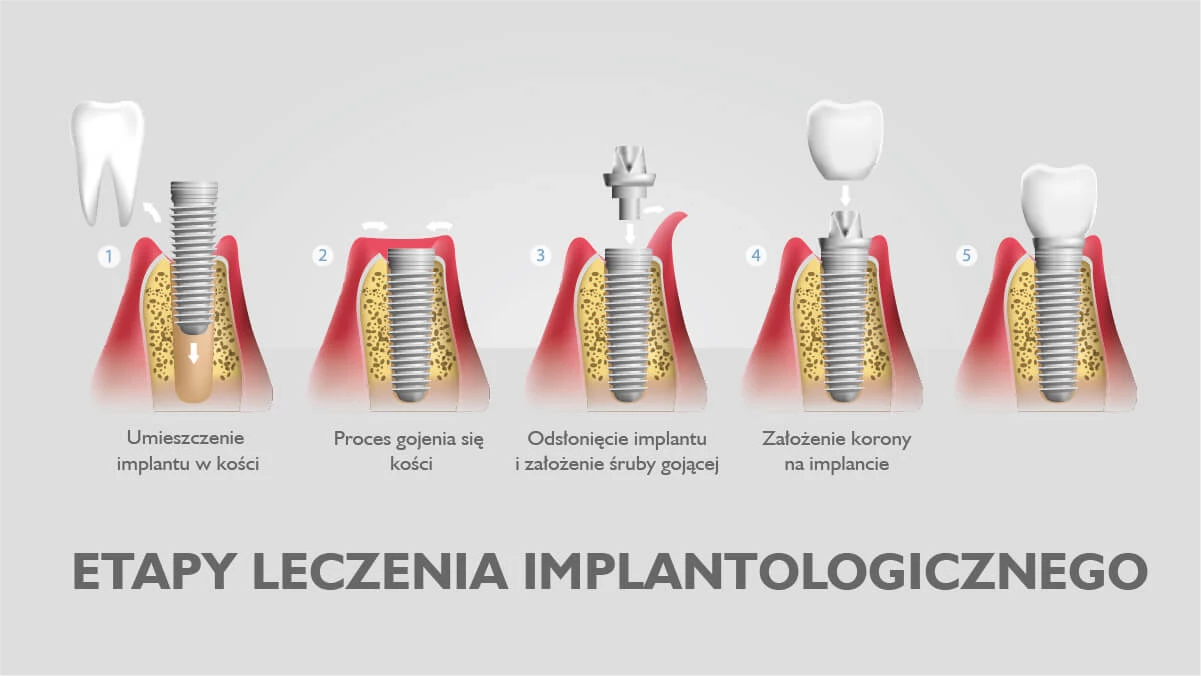 Każdy implant zęba przybiera postać śruby wkręcanej w kości szczęki lub żuchwy