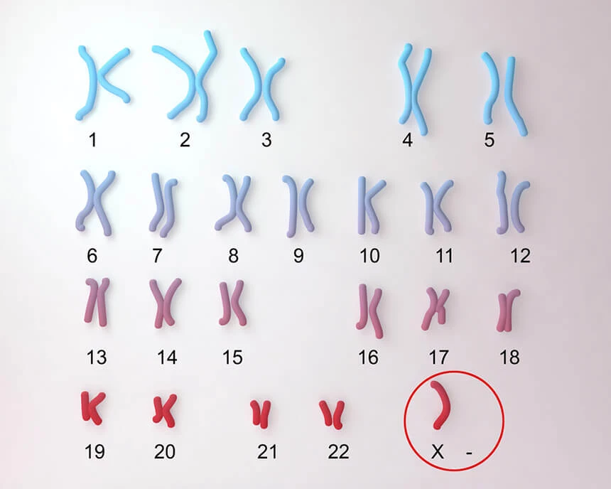 Zespoł Turnera wynika zbraku (lub nieprawidłowej budowy) drugiego z chromosomów X w ostatniej parze kariotypu..