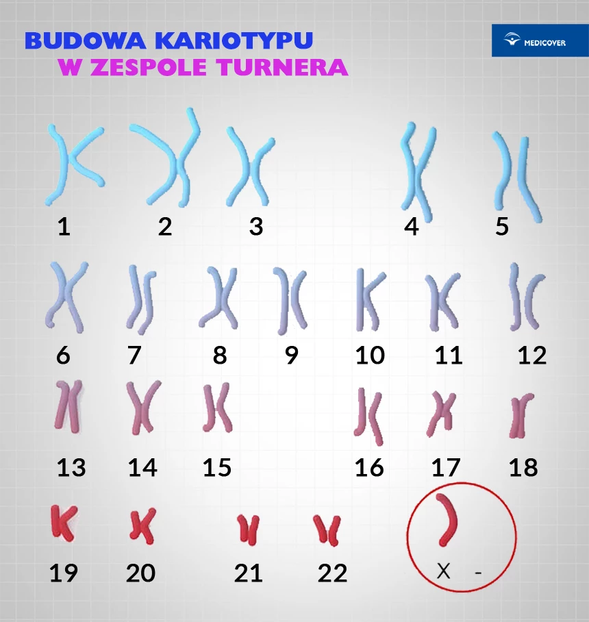 Zespół Turnera występuje w wyniku braku (lub nieprawidłowej budowy) drugiego z chromosomów X w ostatniej parze kariotypu.