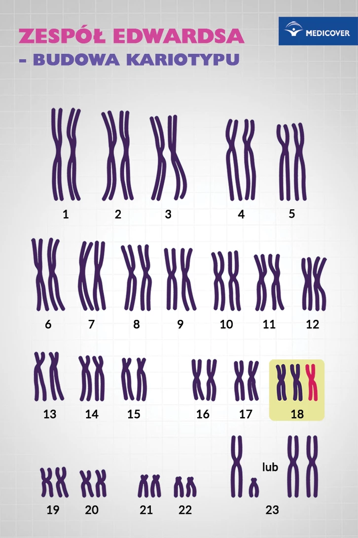 Zespół Edwardsa charakteryzuje się dodatkową obecnością chromosomu 18. 