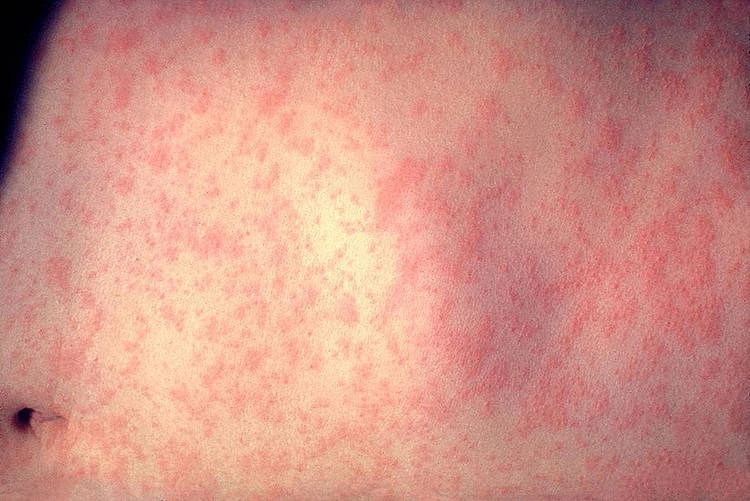 Jak wygląda odra? Charakterystyczna wysypka zaczyna się po ok. 14 dniach od zakażenia. Fot. Centers for Disease Control and Prevention's Public Health Image Library (PHIL), domena publiczna