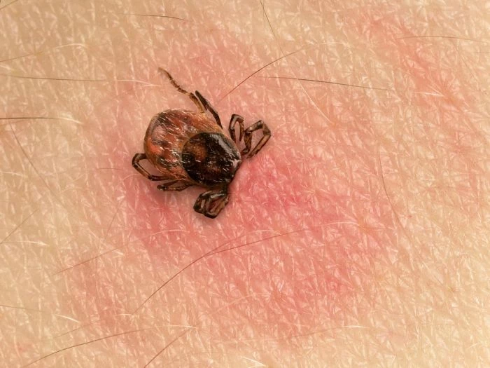 Pierwszym objawem ugryzienia kleszcza jest rumień wędrujący.