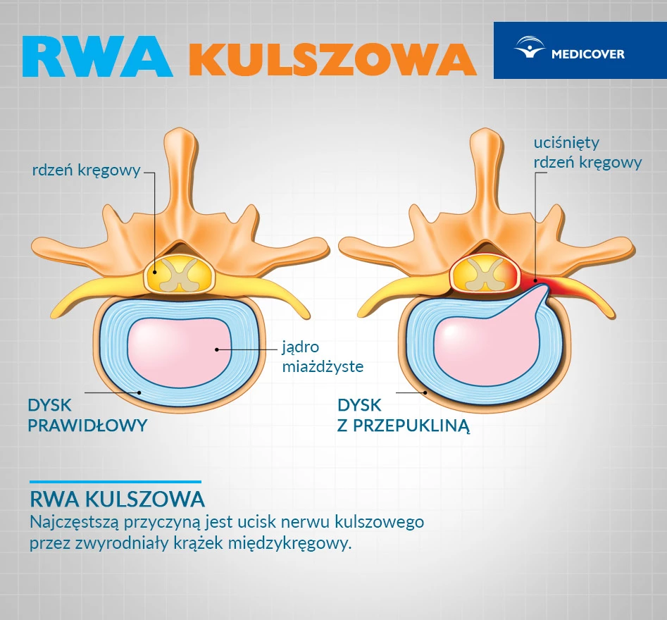Rwa kulszowa - dysk z przepukliną.