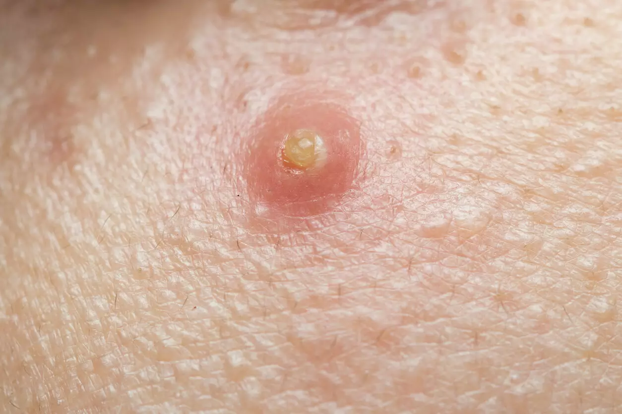 Czyrak jaki lekarz leczy? Najlepiej udać się do dermatologa.