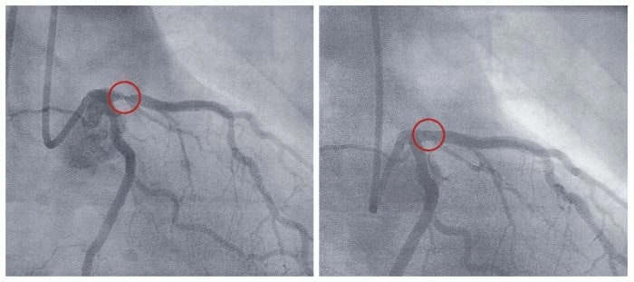 Tętnica przed i po zastosowaniu balonu poszerzającego (angioplastyka)