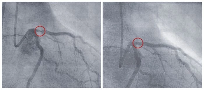 Tętnica przed i&nbsp;po zastosowaniu balonu poszerzającego (angioplastyka)
