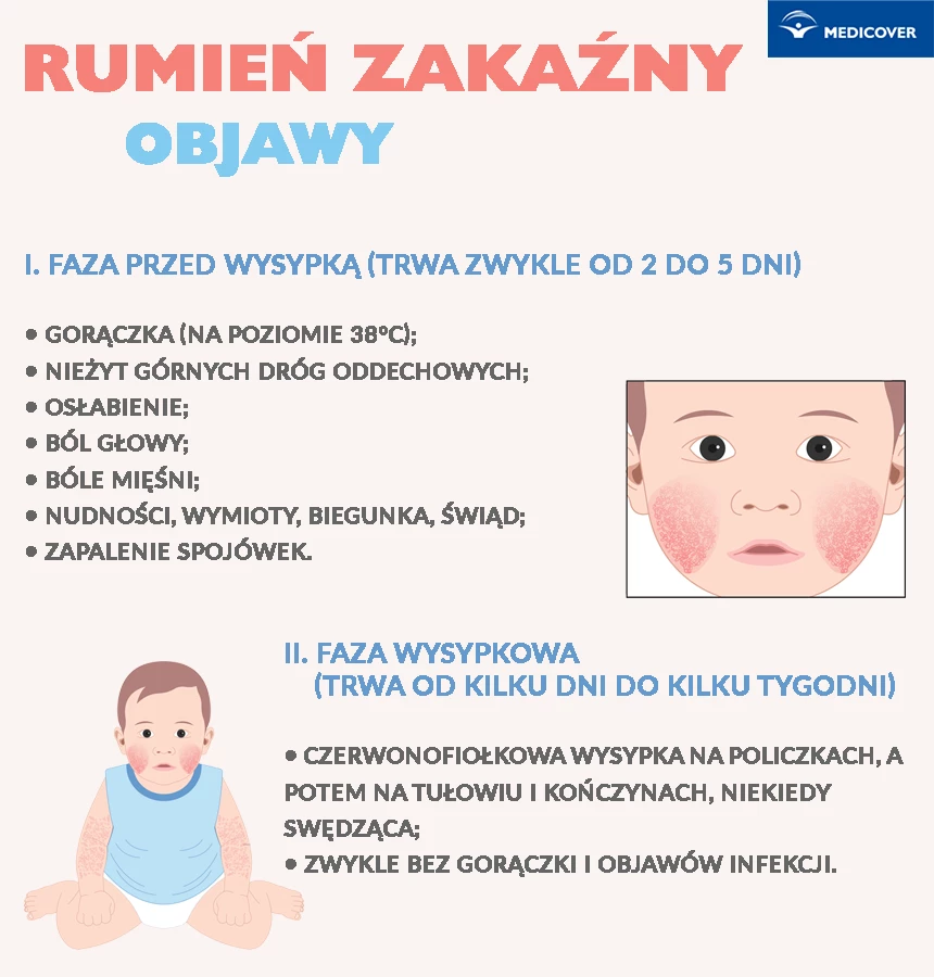 Rumień zakaźny u&nbsp;dzieci i&nbsp;dorosłych - objawy. Jak wygląda rumień zakaźny? Zdjęcie: Pepermpron / Shutterstock