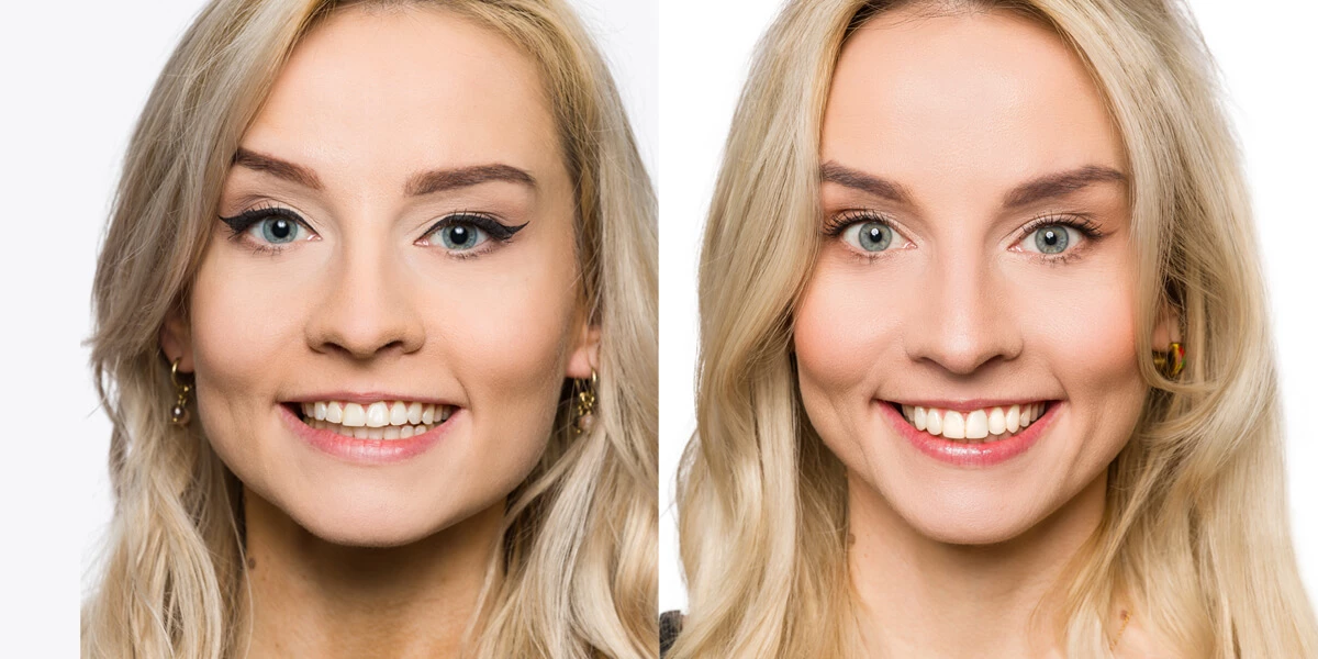 Zabieg bondingu zębów - efekt przed i po