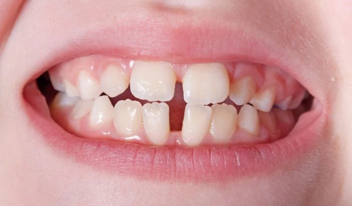 Ortodoncja koryguje wady zgryzu zarówno u dzieci, jak i u dorosłych