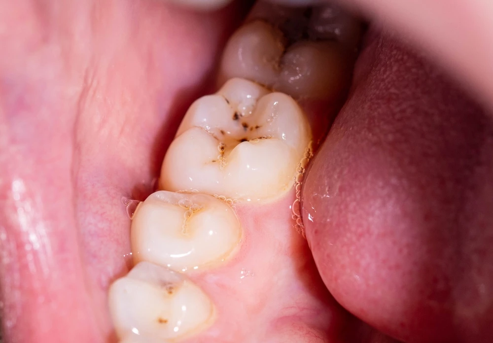 Próchnica zębów to choroba wywoływana przez bakterie.