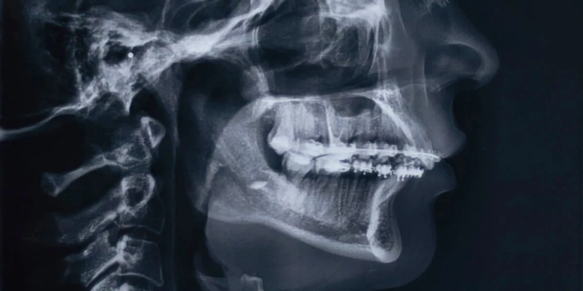 RTG cefalometryczne umożliwia dokładną diagnostykę wad ortodontycznych