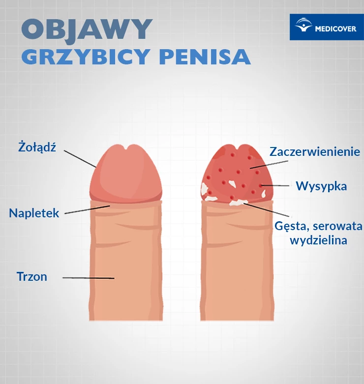 Skonsultuj się z lekarzem w przypadku nawracającej infekcji penisa, (np. gdy zaobserwujesz swędzenie i ból prącia). Grafika: Tru3_Art / Shutterstock