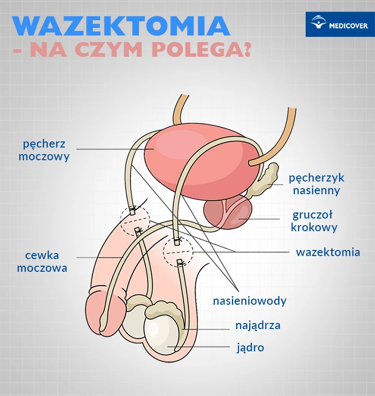 wazektomia infografika