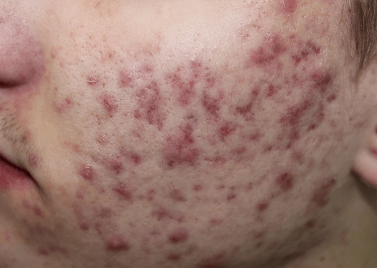 Jak wygląda trądzik młodzieńczy? Zdjęcie: Dermatology11 / Shutterstock