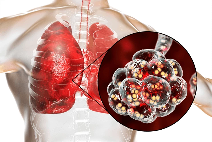 Pneumokoki Streptococcus pneumoniae pod mikroskopem – przyczyna zapalenia płuc i sepsy. Zdjęcie: Kateryna Kon / Shutterstock