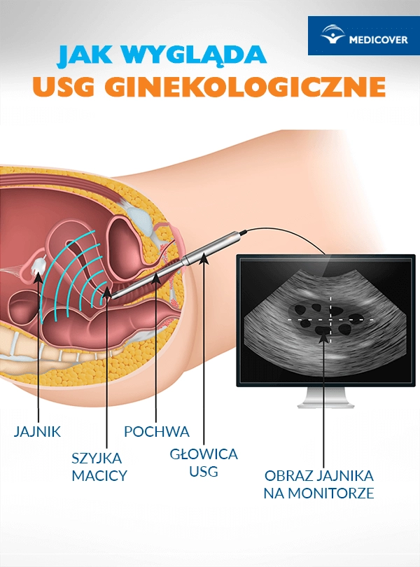 USG ginekologiczne - jak wygląda badanie?