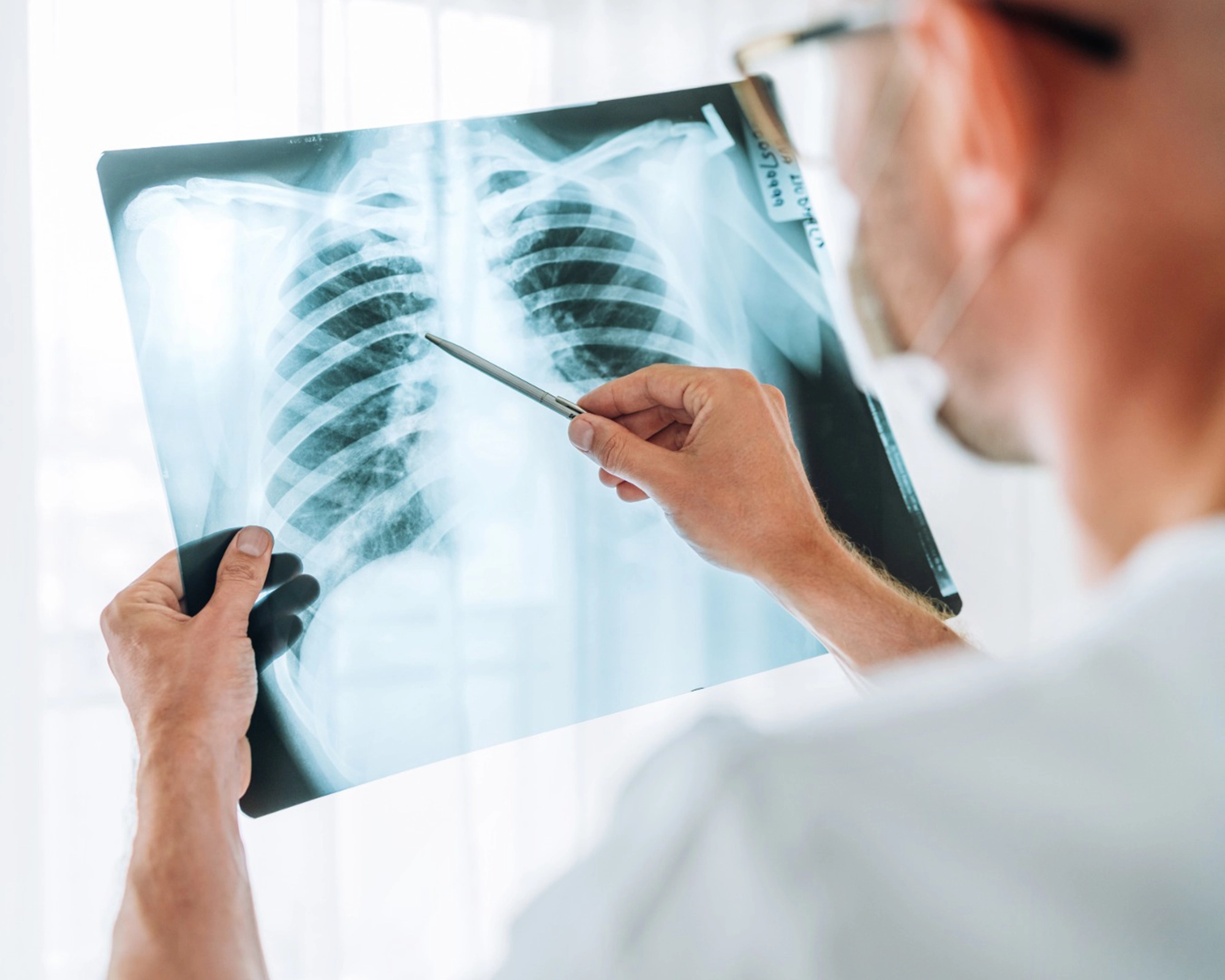 Torakochirurg omawia z pacjentem wynik tomografii komputerowej klatki piersiowej.