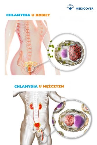 Chlamydia u kobiet i mężczyzn - infografika.
