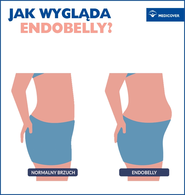 Brzuch endometrioza - jak wygląda. Grafika: Pepermpron / Shutterstock
