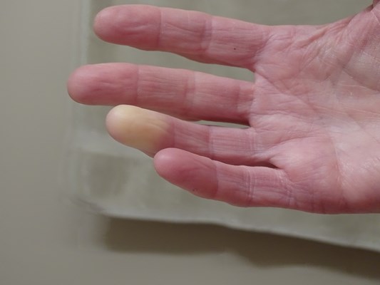 Choroba i&nbsp;zespół Raynauda