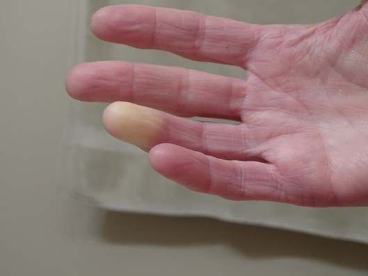 Choroba i&nbsp;zespół Raynauda