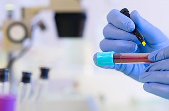 Anemia sierpowata - objawy i leczenie anemii sierpowatej