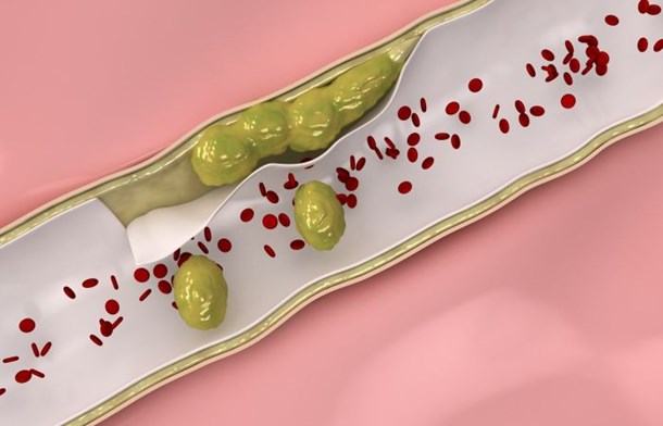 Podwyższony poziom cholesterolu może być przyczyną wielu chorób