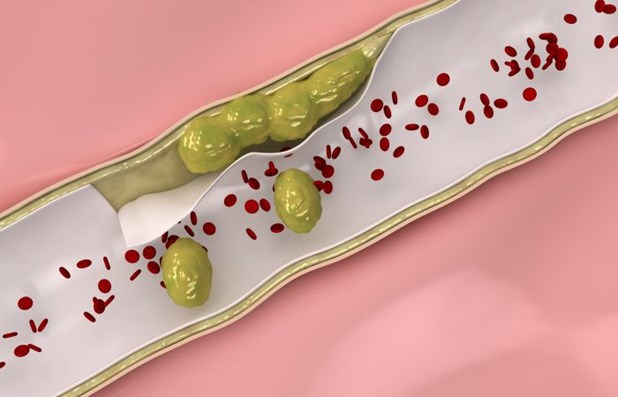 Podwyższony poziom cholesterolu może być przyczyną wielu chorób