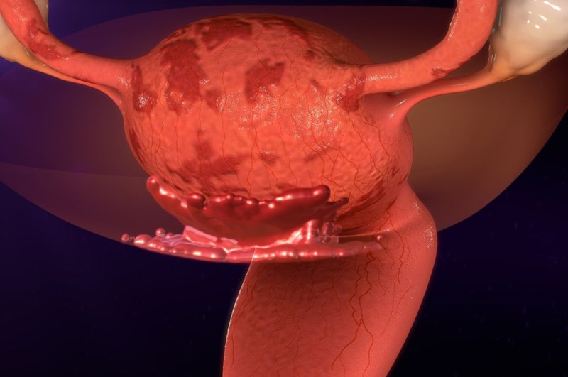 Endometrioza – diagnoza, objawy i leczenie endometriozy
