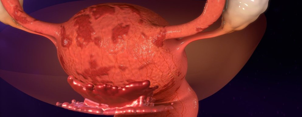 Objawy i&nbsp;leczenie endometriozy