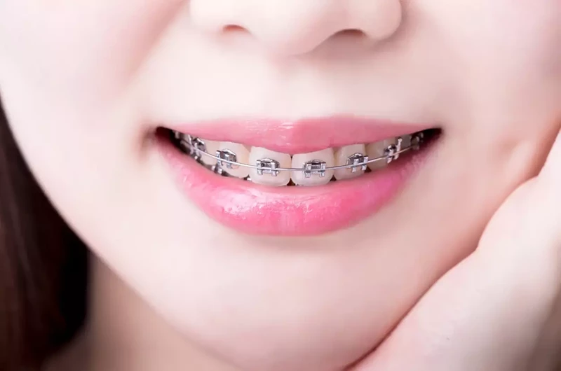 What is progenia?