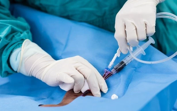Małoinwazyjne operacje żylaków kończyn dolnych