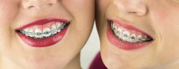 Aparat ortodontyczny – kiedy nosić aparat na zęby?