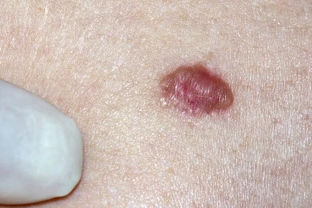 Disease - basal cell neoplasm
