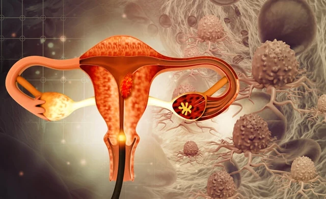 Disease - cancer of the cervix