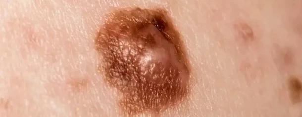 Melanoma 