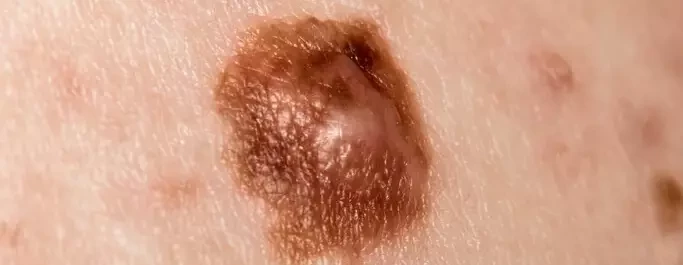 Melanoma 