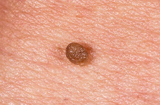 Objawy wirusa HPV