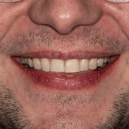 Nowy uśmiech po jednej wizycie