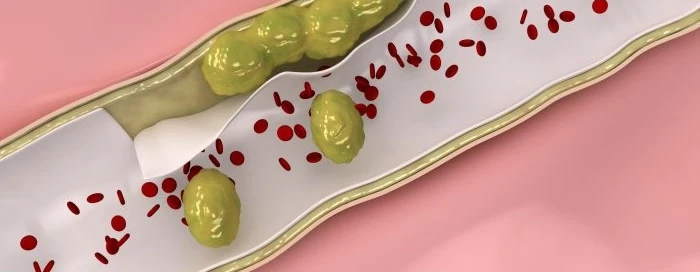 Podwyższony poziom cholesterolu może być przyczyną wielu chorób