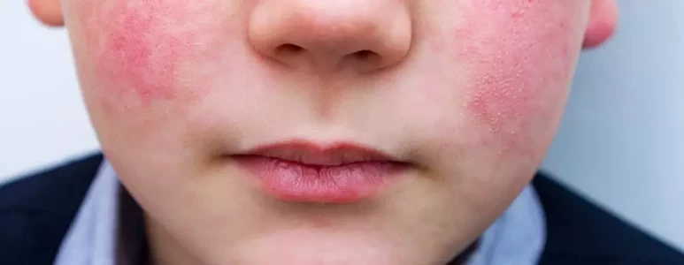 Rumień zakaźny to choroba zakaźna, w&nbsp;szczególności występuje u&nbsp;dzieci w&nbsp;wieku przedszkolnym.