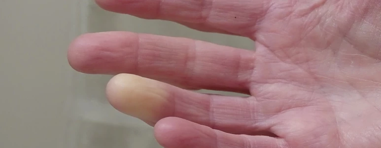Choroba i&nbsp;zespół Raynauda