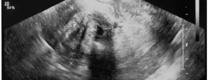 USG endometriozy głęboko naciekającej z&nbsp;użyciem kontrastu żelowego sonovaginografia